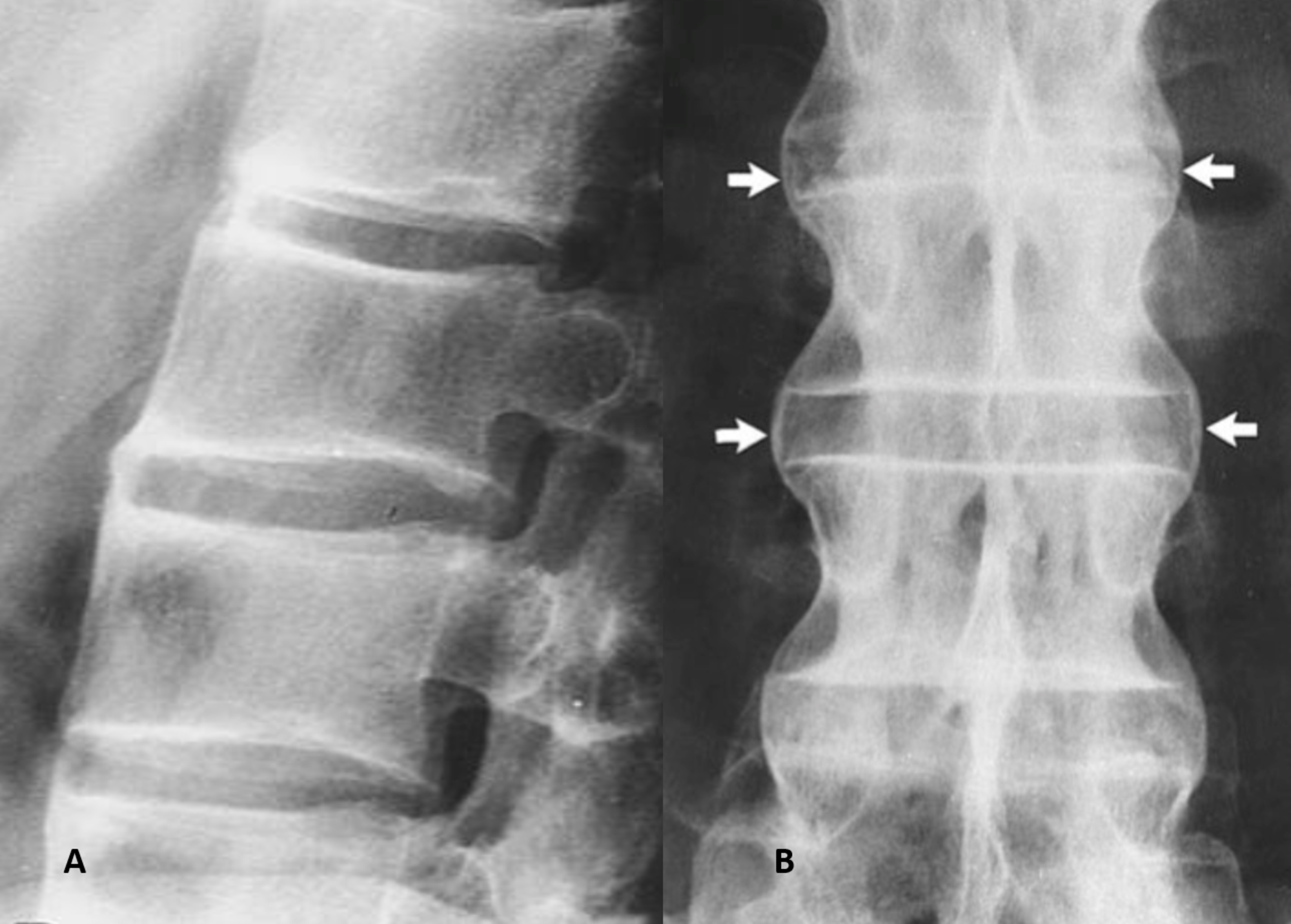 ankylosing spondylitis bamboo spine