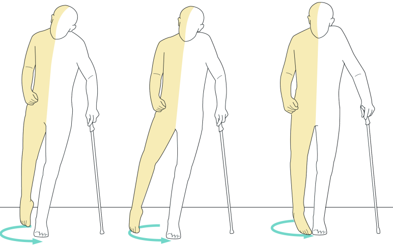 foot drop adalah