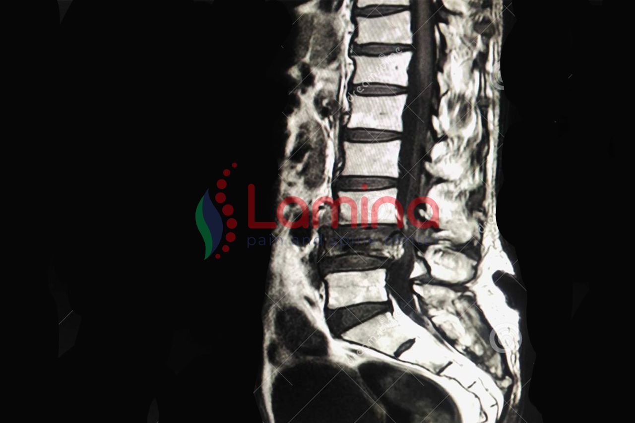 penyakit osteoporosis