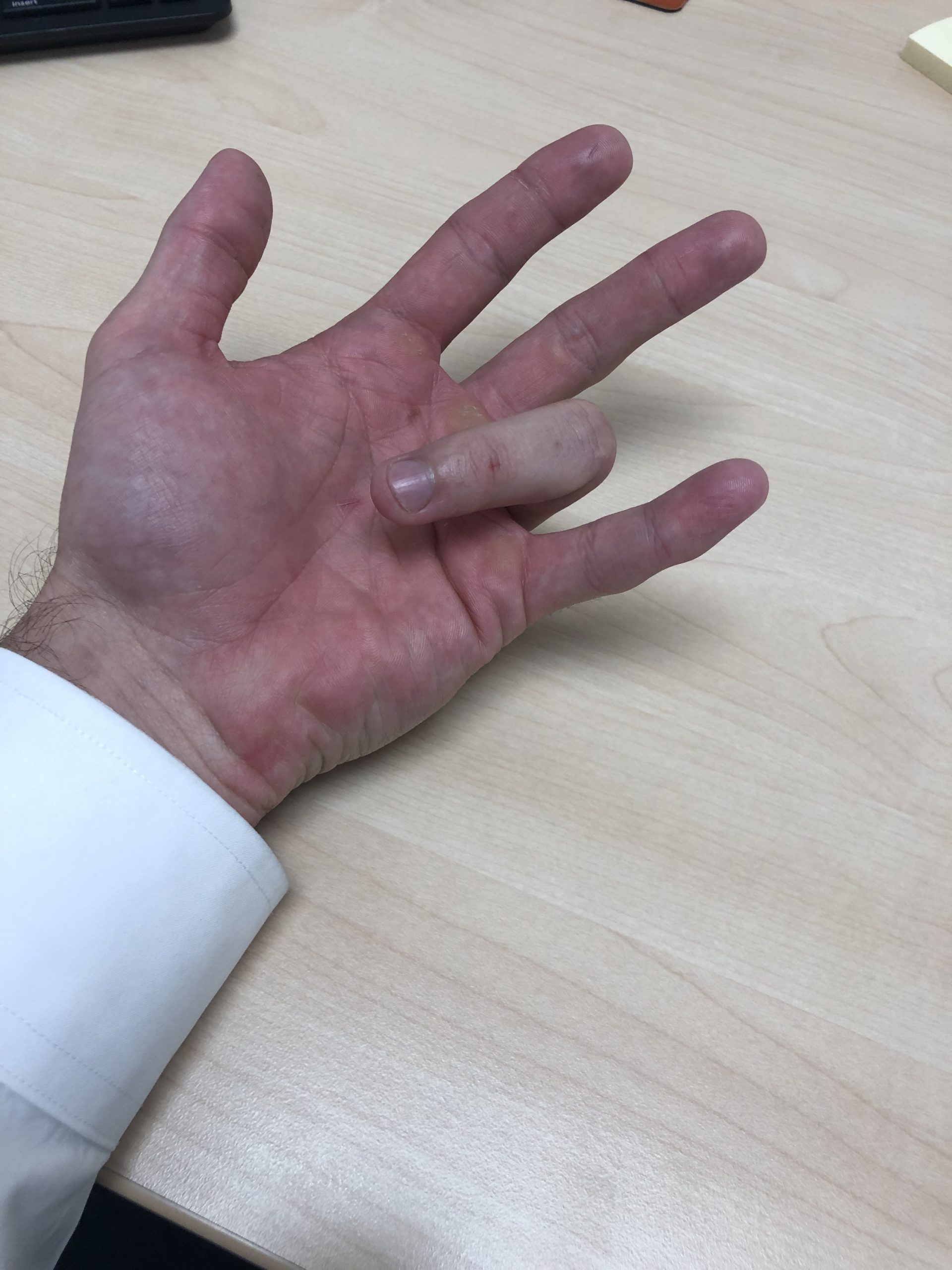 trigger finger