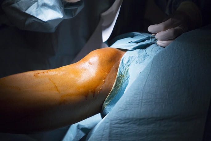 ligamentoplasty